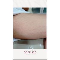 Estrías, cómo prevenir y tratar las huellas que deja en la piel         