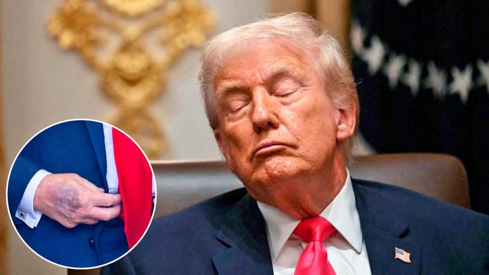 03_01_2025_trump_hematomas_manos_afp_g