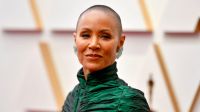 Alopecia