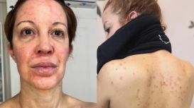 El dramático momento de salud de Miriam Lanzoni: "Noches interminables por dormir envuelta en papel film"