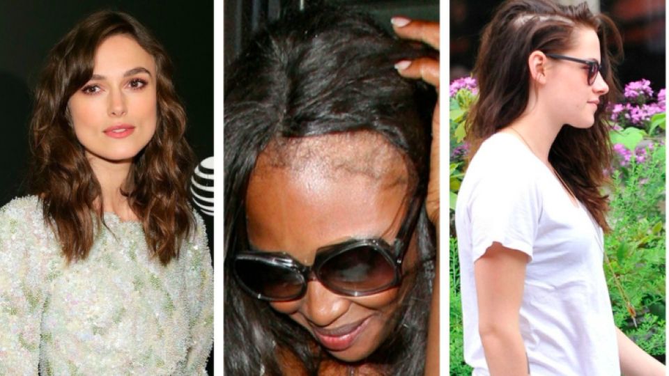 Famosos y famosas que han tenido que lidiar con la alopecia
