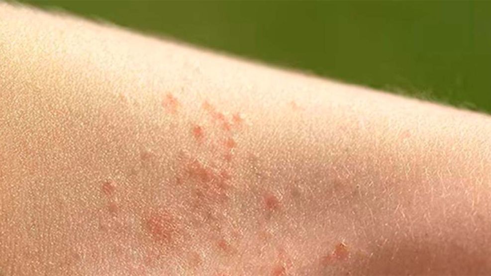 Miliaria sarpullido por el calor 08012026