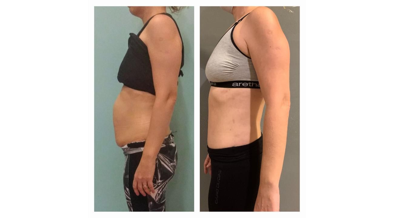 Diástasis abdominal: una condición poco conocida que afecta tu salud y que podría impactar en tu autoestima