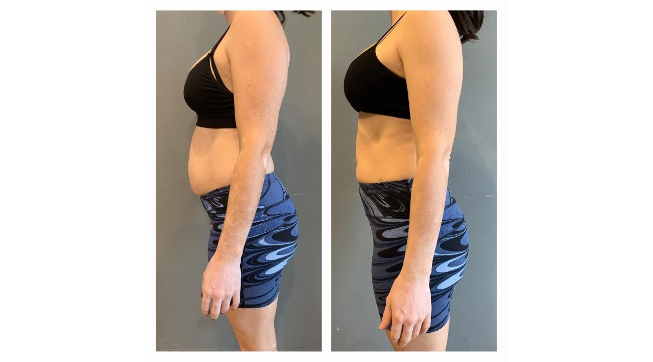 Diástasis abdominal: una condición poco conocida que afecta tu salud y que podría impactar en tu autoestima