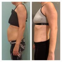 Diástasis abdominal: una condición poco conocida que afecta tu salud y que podría impactar en tu autoestima