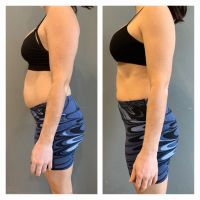 Diástasis abdominal: una condición poco conocida que afecta tu salud y que podría impactar en tu autoestima