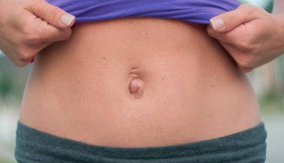 Hernia Umbilical y Diástasis: la asociación que afecta la salud y la estética femenina