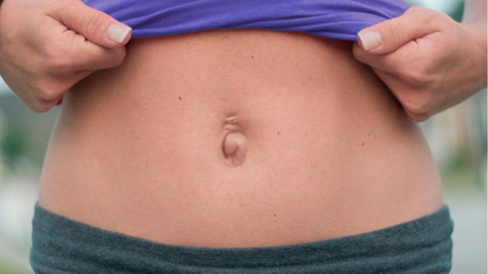 Hernia Umbilical y Diástasis: la asociación que afecta la salud y la estética femenina