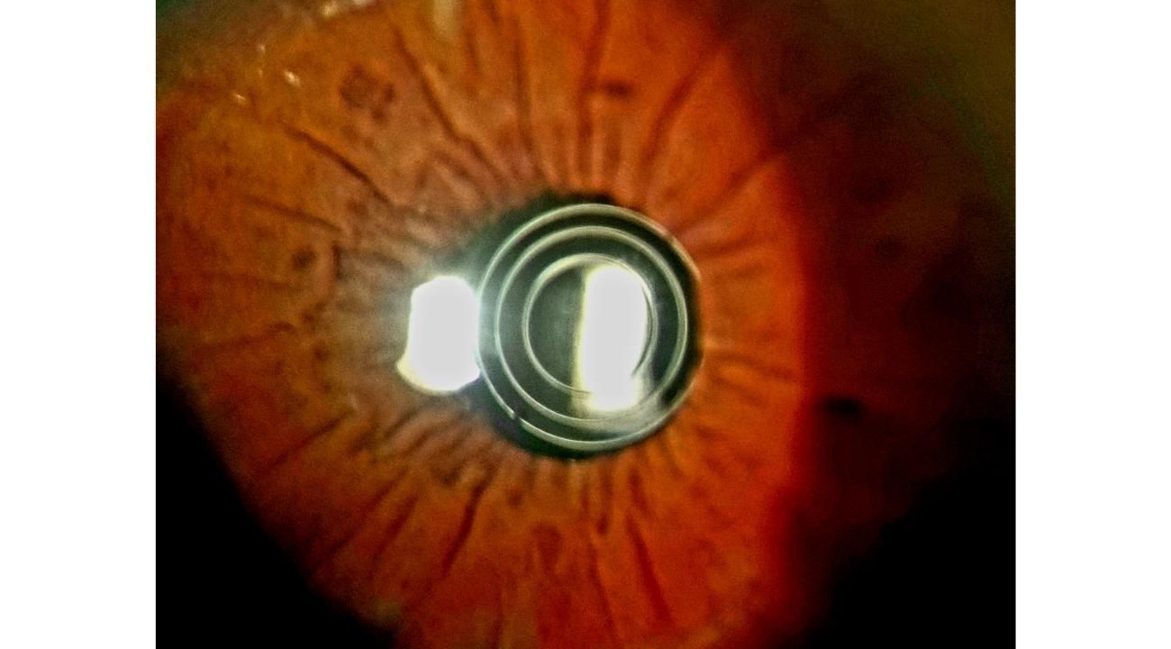 Cirugía Premium de la Presbicia: el verdadero secreto de su éxito