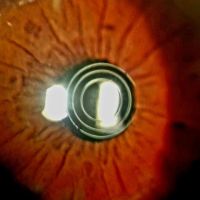 Cirugía Premium de la Presbicia: el verdadero secreto de su éxito