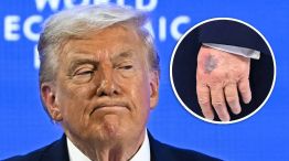 Donald Trump - moretones 22012026