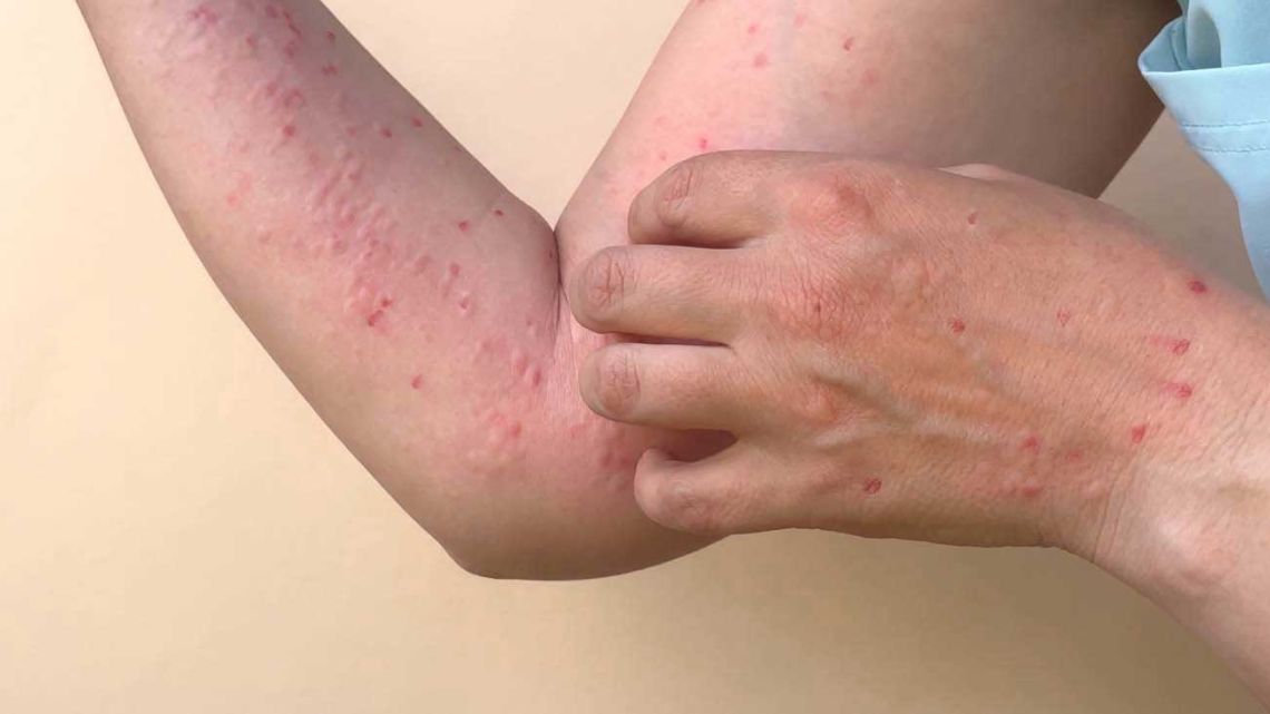 Sarampión: síntomas y prevención