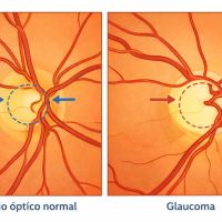 Glaucoma: el ladrón silencioso de la visión