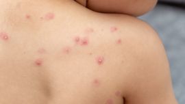 Confirman un nuevo caso de Mpox en CABA: qué es, cómo se contagia y cuáles son los síntomas
