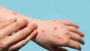 El Ministerio de Salud de la Nación informó que se detectó el primer caso de viruela del mono.