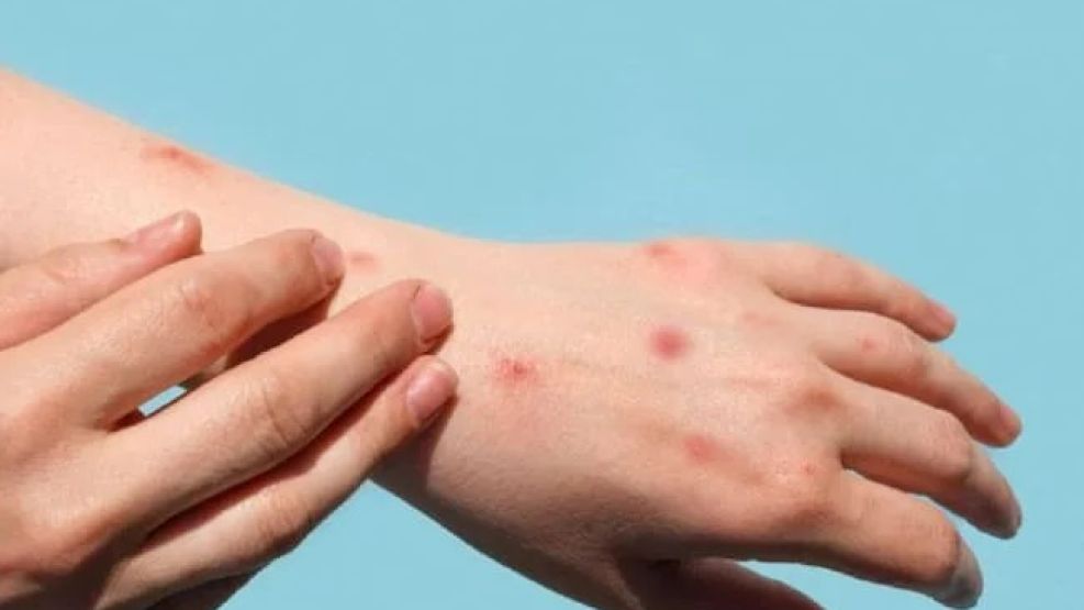 El Ministerio de Salud de la Nación informó que se detectó el primer caso de viruela del mono.