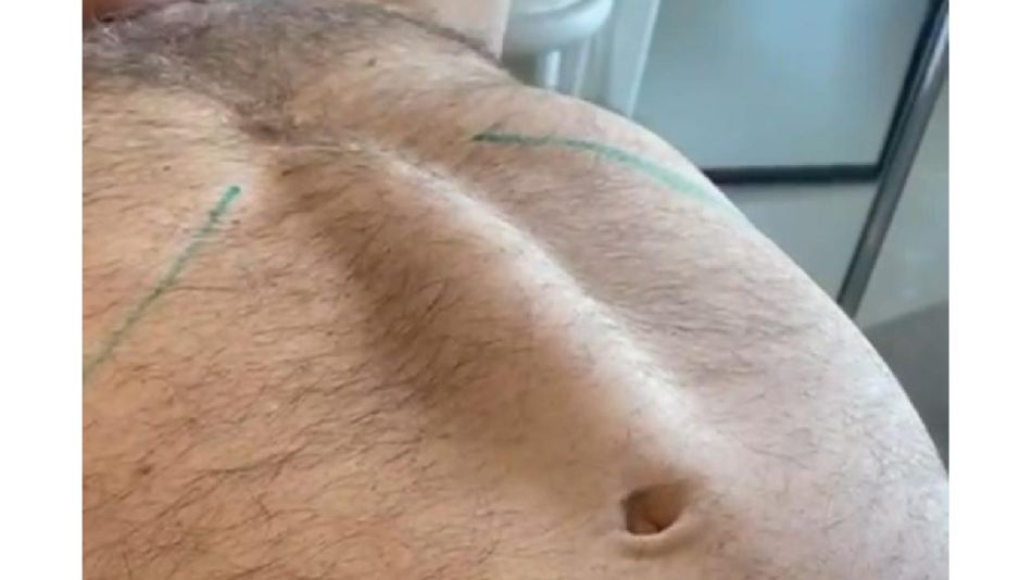 DIÁSTASIS EN HOMBRES: signos y síntomas