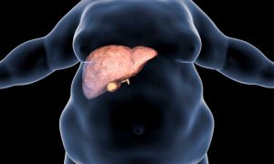 El hígado graso crecerá un 42% para el 2050