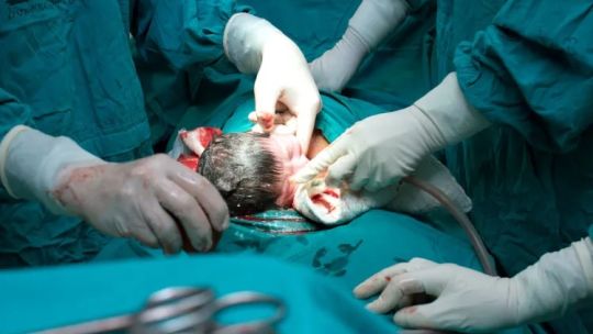 En Argentina 4 de cada 10 bebes nacen por cesárea, el triple de lo recomendado