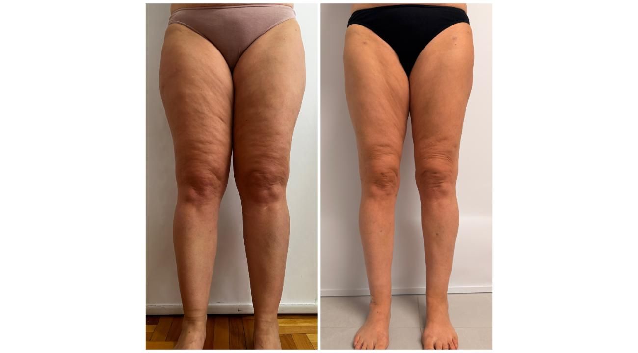 Dra. Priscila Orquiguil (MN: 153.333): “El lipedema existe, tiene diagnóstico y tratamiento”