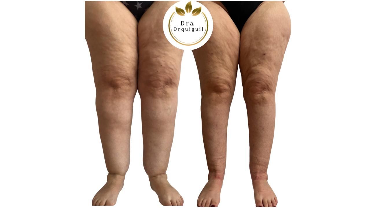 Dra. Priscila Orquiguil (MN: 153.333): “El lipedema existe, tiene diagnóstico y tratamiento”