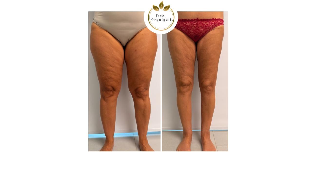 Dra. Priscila Orquiguil (MN: 153.333): “El lipedema existe, tiene diagnóstico y tratamiento”