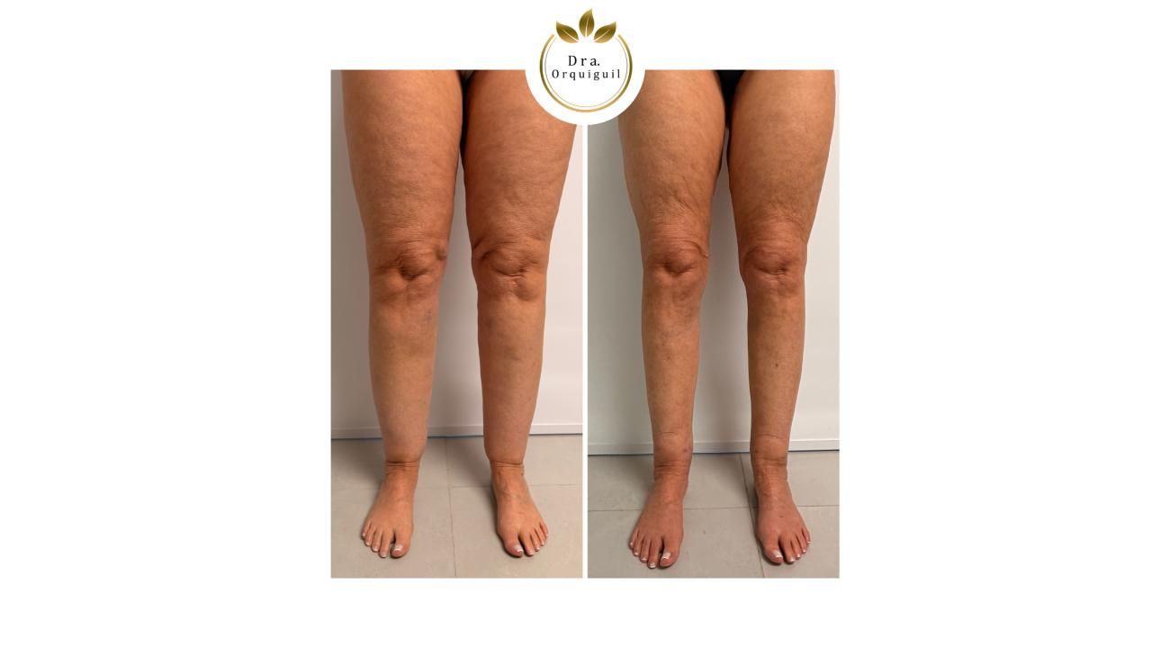 Dra. Priscila Orquiguil (MN: 153.333): “El lipedema existe, tiene diagnóstico y tratamiento”