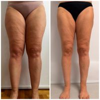 Dra. Priscila Orquiguil (MN: 153.333): “El lipedema existe, tiene diagnóstico y tratamiento”