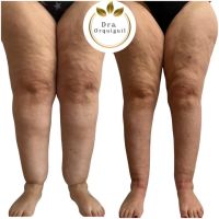 Dra. Priscila Orquiguil (MN: 153.333): “El lipedema existe, tiene diagnóstico y tratamiento”