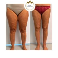 Dra. Priscila Orquiguil (MN: 153.333): “El lipedema existe, tiene diagnóstico y tratamiento”