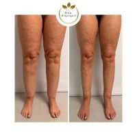 Dra. Priscila Orquiguil (MN: 153.333): “El lipedema existe, tiene diagnóstico y tratamiento”