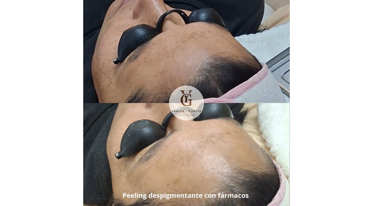 Peelings y tratamientos regenerativos: la nueva era del rejuvenecimiento facial