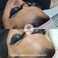 Peelings y tratamientos regenerativos: la nueva era del rejuvenecimiento facial
