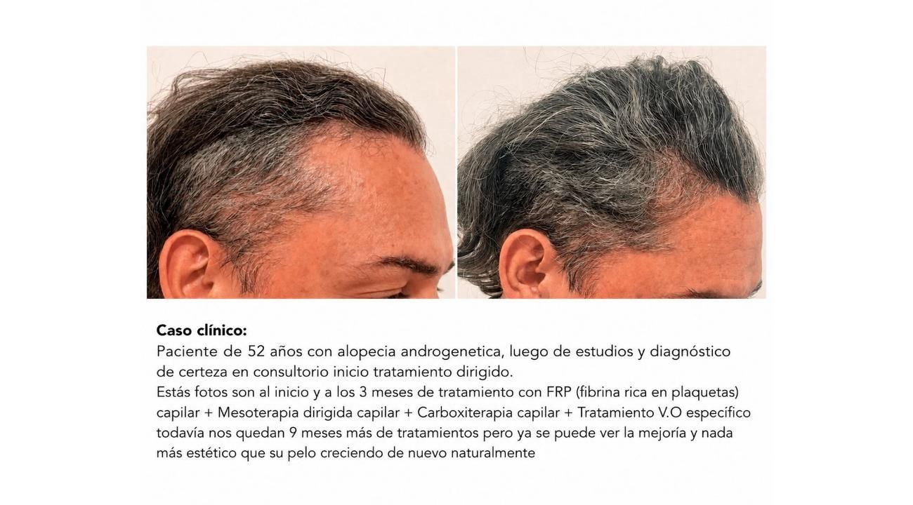 TRASPLANTES CAPILARES: LO QUE MUCHOS PACIENTES DESCUBREN DEMASIADO TARDE