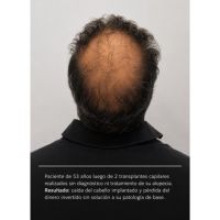 TRASPLANTES CAPILARES: LO QUE MUCHOS PACIENTES DESCUBREN DEMASIADO TARDE