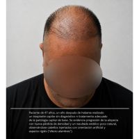TRASPLANTES CAPILARES: LO QUE MUCHOS PACIENTES DESCUBREN DEMASIADO TARDE