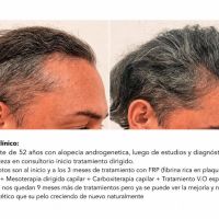 TRASPLANTES CAPILARES: LO QUE MUCHOS PACIENTES DESCUBREN DEMASIADO TARDE