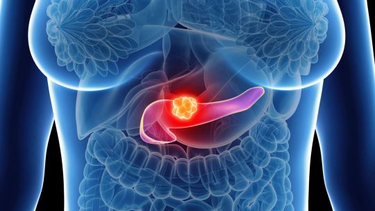 Cáncer de páncreas: una píldora duplica la supervivencia de pacientes graves