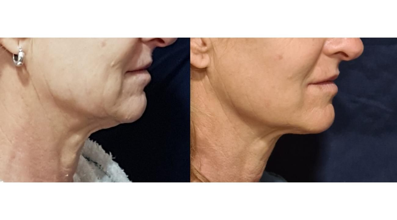 El éxito del rejuvenecimiento facial sin cirugía