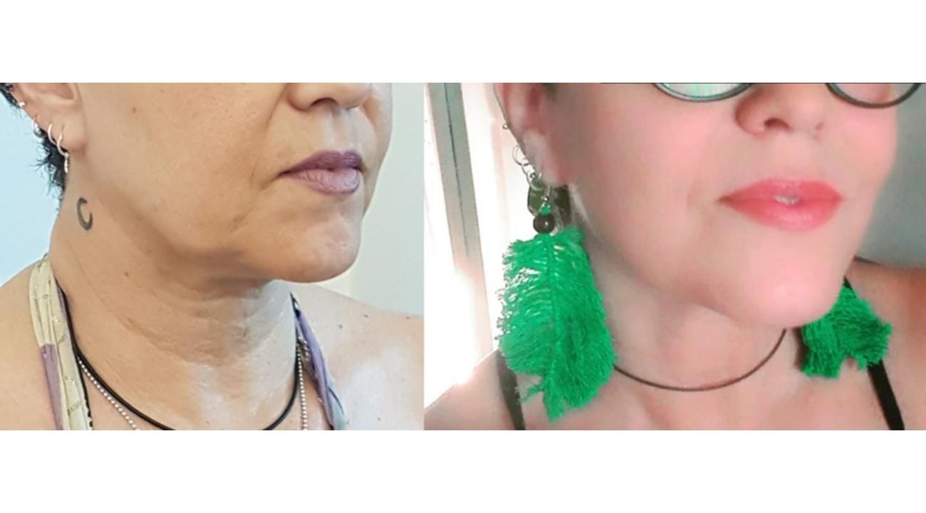 El éxito del rejuvenecimiento facial sin cirugía