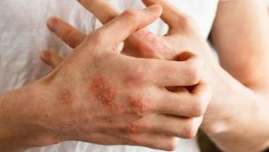 artritis