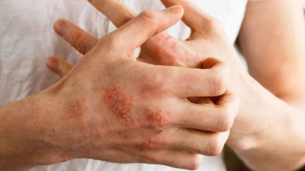 artritis