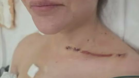 Nadia Beller compartió nuevas imágenes de las heridas que sufrió tras el ataque de sicarios: "Que Dios te perdone Fernando Cerimedo"