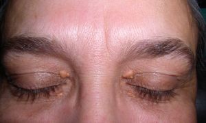 Xantelasma