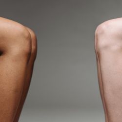Lipedema