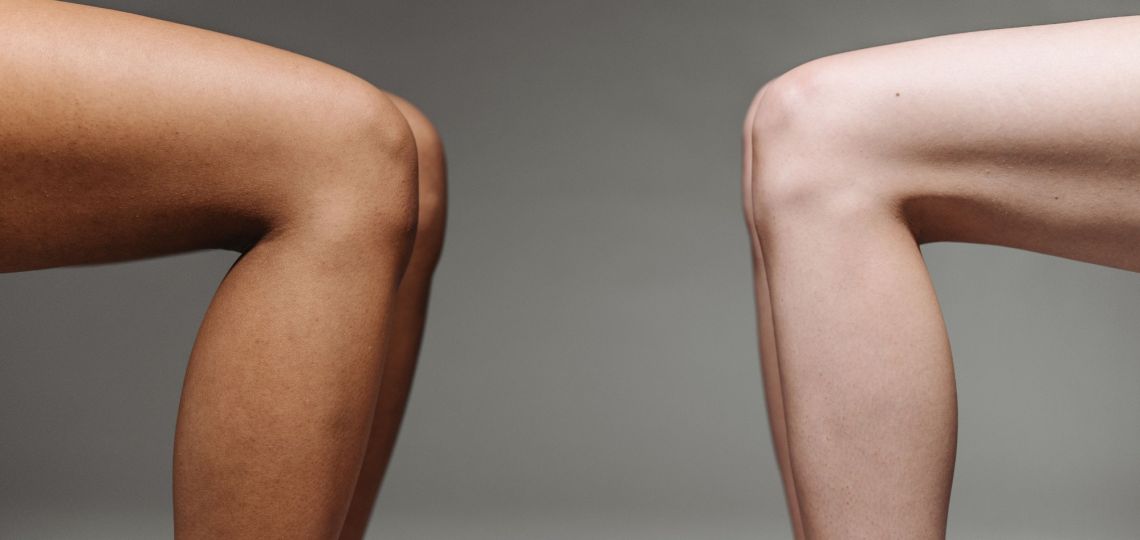 Lipedema: qué es y por qué necesita un tratamiento integral