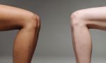 Lipedema: qué es y por qué necesita un tratamiento integral