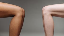 Lipedema: qué es y por qué necesita un tratamiento integral