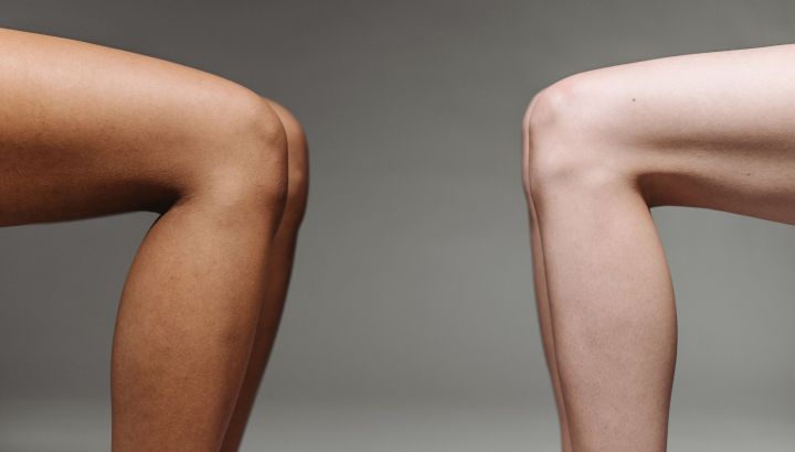 Lipedema: qué es y por qué necesita un tratamiento integral