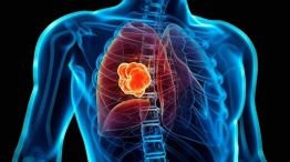 nódulos pulmonares